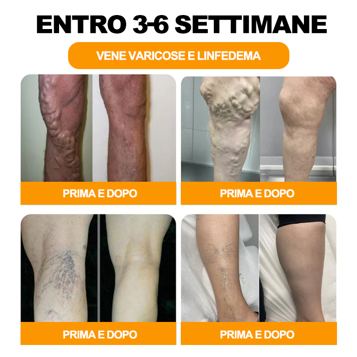 Sono rimaste solo 8 confezioni! Godetevi il 30% di sconto! Gli esperti consigliano di acquistare da 4 a 6 confezioni per un ripristino totale della salute del sistema linfatico. Non perdete questa occasione o dovrete aspettare l'anno prossimo!🦵👩‍⚕️